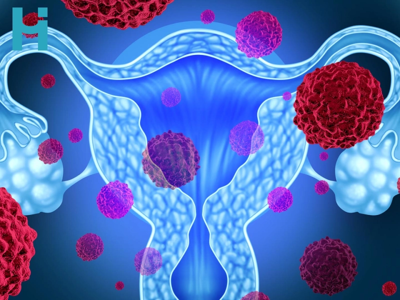 فیبروم رحم، علائم و درمان آن